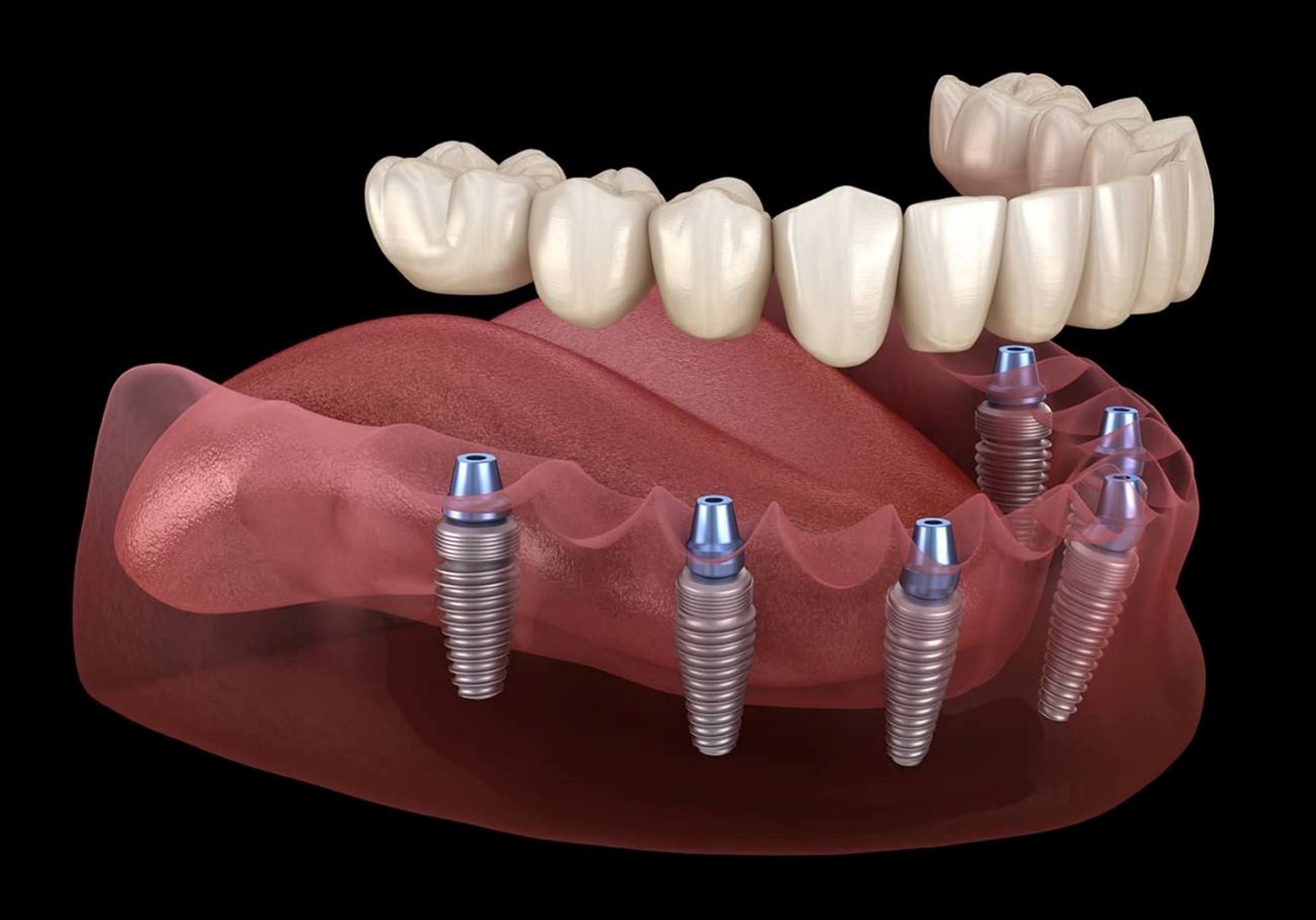 implantes dentales en leganes